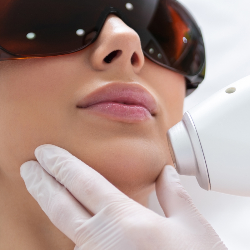 What is IPL Laser Treatment at Angelic Lift