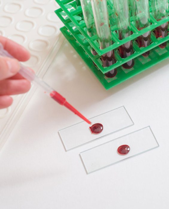 Scientist working with blood sample in laboratory Scientist working with blood sample in laboratory