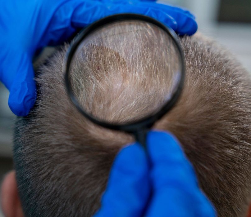 Hair-Loss-Treatment-angelic