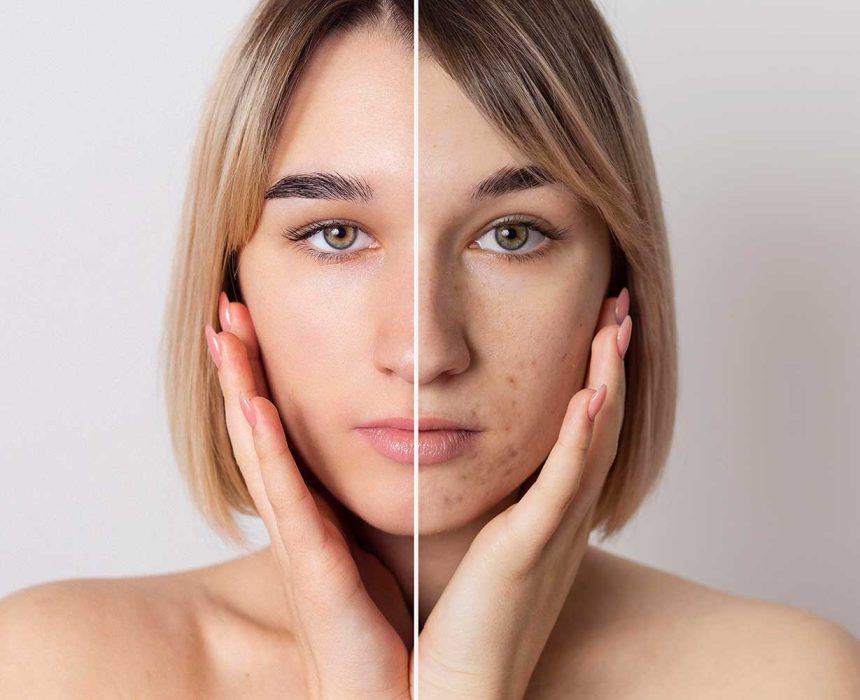 What-to-Expect-microneedling What-to-Expect-microneedling