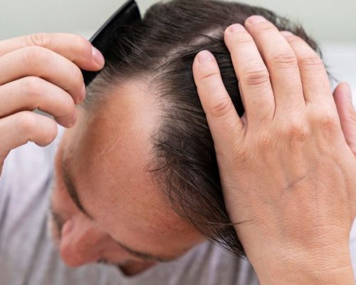 Hair Loss treatment